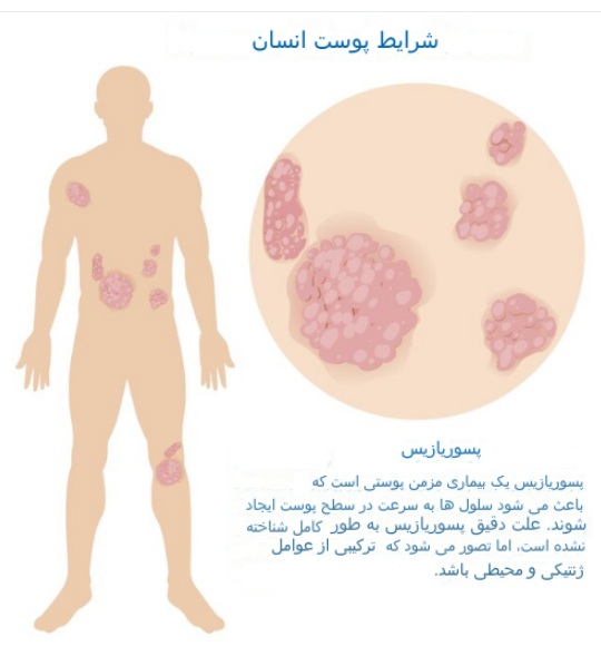 پسوریازیس....