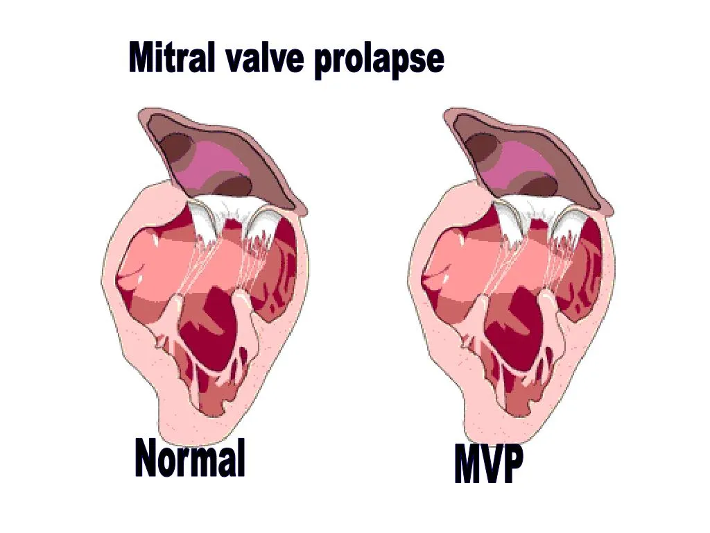 پرولاپس دریچه میترال