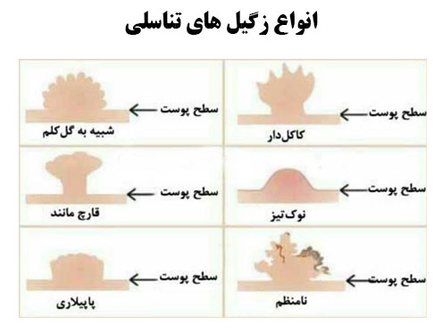 زگیل تناسلی انواع آن