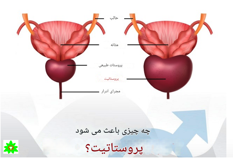 پروستات و پروستاتیت.