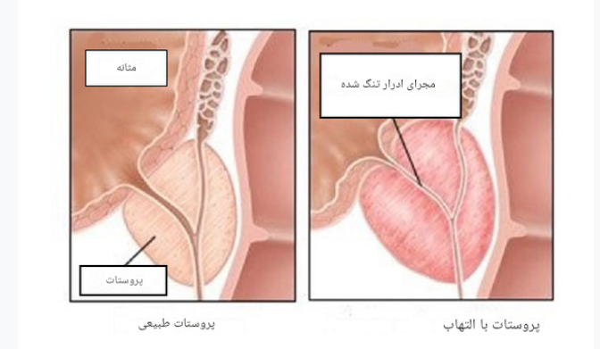 پروستات و پروستاتیت....