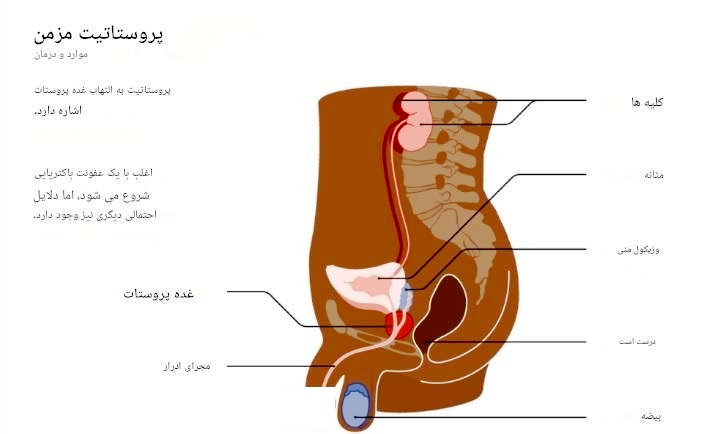 پروستات و پروستاتیت..