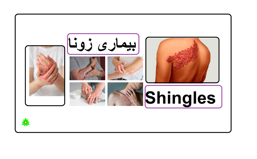 بیماری زونا و درمان آن