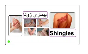 بیماری زونا و درمان آن