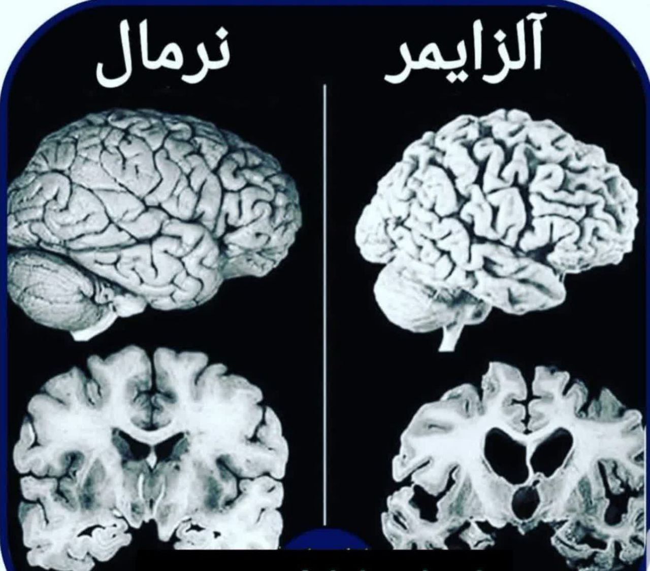 علل اصلی آلزایمر