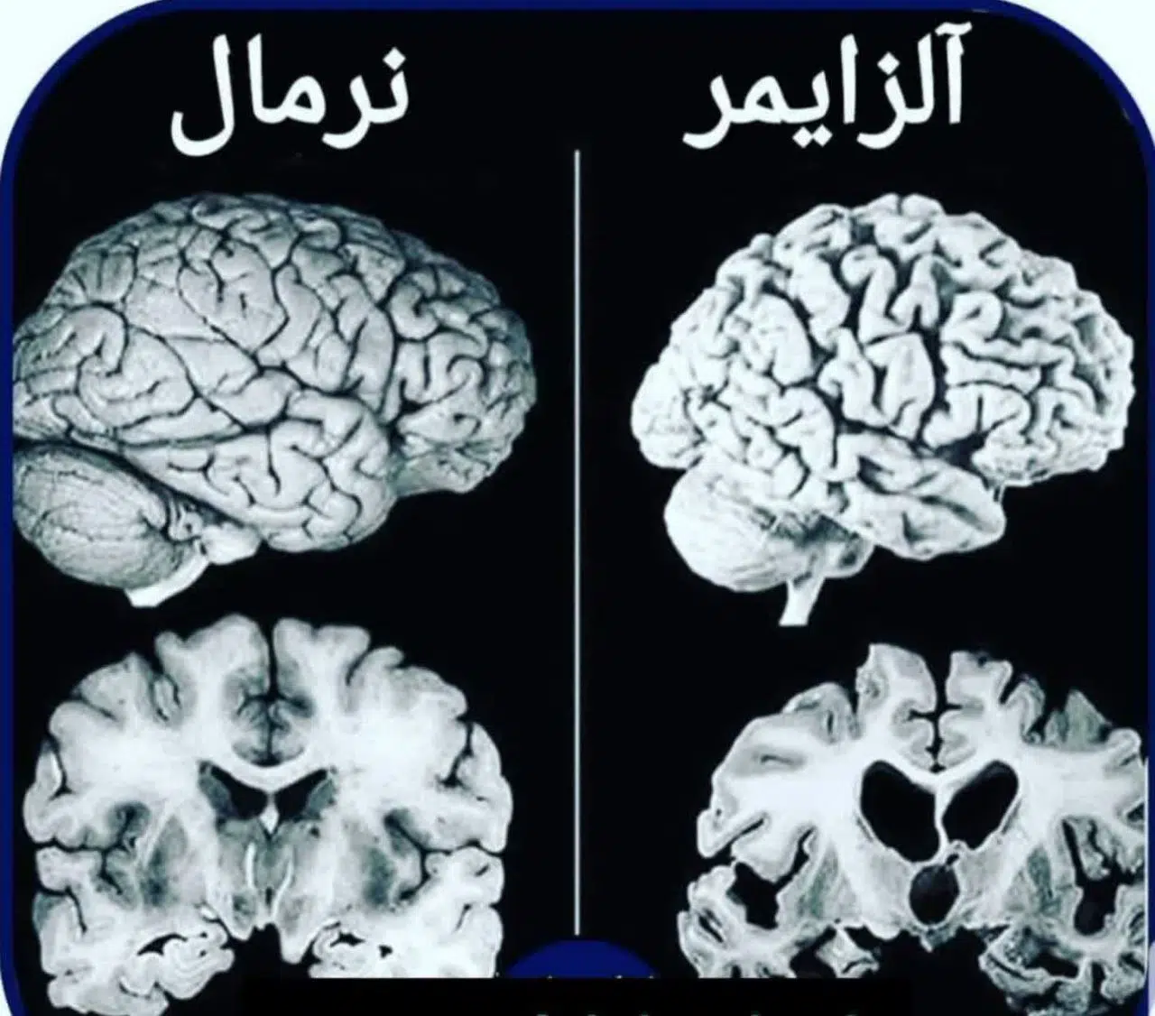 علل اصلی آلزایمر