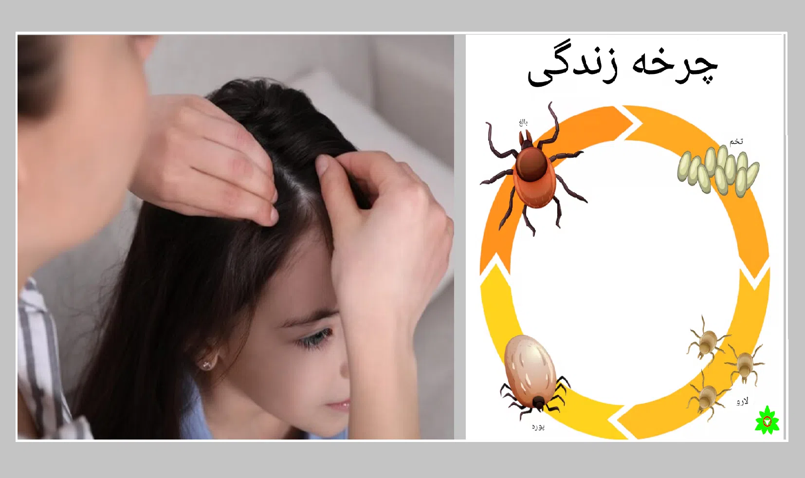 شپش سر علت دکتر حسن اکبری.