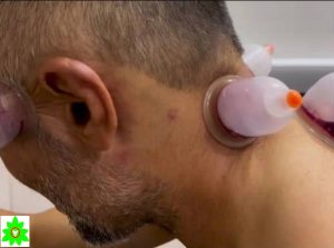 حجامت برای چه مزاج‌هایی